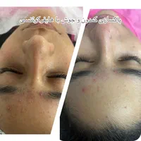 فیشال و نخ کلاژن به جای بوتاکس|خدمات آرایشگری و زیبایی|اصفهان, کوی ولی عصر|دیوار
