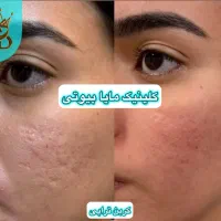 درمان لک،کک و مک(مایابیوتی)اولین مرکز کربن تراپی