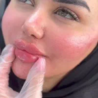 تخفیف پاییزه ژل و‌بوتاکس