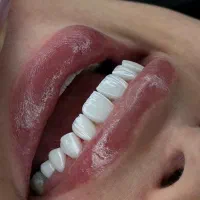 ونیر لبه شفاف،اوردنچر،لمینیت