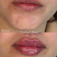 جشنواره تخفیف ژل لب و بوتاکس