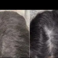 از کچلی خسته شدی