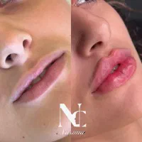 تزریق فیلر بوتاکس،نخ لیفتینگ بانصف قیمت بازار|خدمات آرایشگری و زیبایی|کرمانشاه, |دیوار