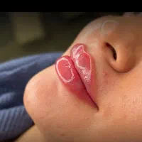 تزریق فیلر لب و بوتاکس