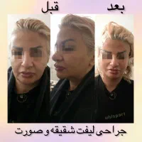 ژل بوتاکس ساکشن چربی نخ لیزر PRPجراحی زیبایی سهند|خدمات آرایشگری و زیبایی|سهند, |دیوار