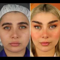 عمل و جراحی بینی 23تا25 میلیون /مشاوره رایگان|خدمات آرایشگری و زیبایی|کرج, عظیمیه|دیوار