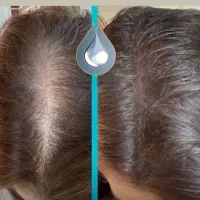 اگزوزوم تراپی مو وخاویارتراپی پوست