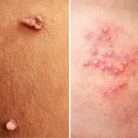 رفع ریشه ای زگیل و تبخال دائمی