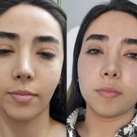 آموزش پیشرفته ژل وبوتاکس پی آرپی وبایوفیلر