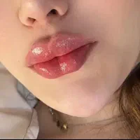 تزریق ژل لب،مادلینگ،فیلر،لیفت نخ،جوانساز