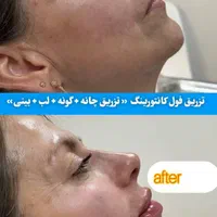 ژل و بوتاکس مرو فیلر توسط دکتر تخفیف ۳۰ ٪|خدمات آرایشگری و زیبایی|مشهد, کوثر|دیوار