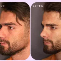 طراحیHipباسن فیلربادی ژل سینه بینی ابرو غبغب لاغری|خدمات زیبایی و سلامت|مشهد, هفت تیر (آب و برق)|دیوار