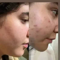 آنالیز رایگان پوست مو و نوشتن روتین مناسب شما
