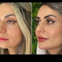 فیلر.ژل.بوتاکس.زاویه سازی.پی ارپی فول فیس|خدمات آرایشگری و زیبایی|مشهد, سناباد|دیوار