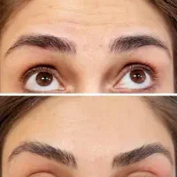 بوتاکس تخصصی در کلینیک زیبایی برنا