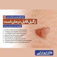 درمان قطعی انواع  زگیل و میخچه