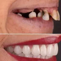 الان ایمپلنت کن، ۱۲ماهه پرداخت کن