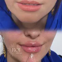 ژل وبوتاکس خدمات زیبایی