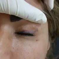 خدافظی با تتوهای قدیمی/50%تخفیف ریموو تخصصی