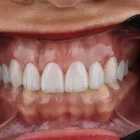 کامپوزیت دندان روکش سرامیکی ایمپلنت لمینت