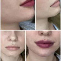 مدل ژل بوتاکس و پیرسینگ|خدمات آرایشگری و زیبایی|فولادشهر, مسکن مهر فولادشهر|دیوار