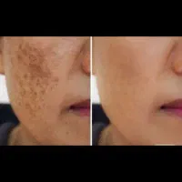محصولات برای رفع لک های پوستی