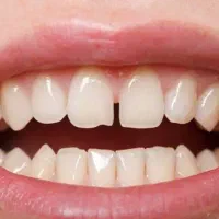 کشیدن دندان های کرسی توسط دانشجو