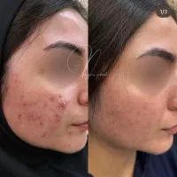 مدل جهت کار درمان تلفیقی پوست|خدمات آرایشگری و زیبایی|چالوس, |دیوار