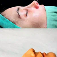 جراحی بینی در تهران با آف ۵۰درصد،جشنواره آذر|خدمات آرایشگری و زیبایی|پاکدشت, پاکدشت (مامازند)|دیوار