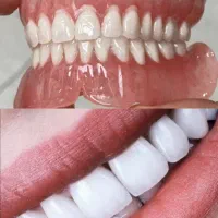 ساخت دندان مصنوعی متحرک فول دنچر