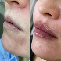 تزریق بوتاکس و فیلر با تخفیف ویژه|خدمات آرایشگری و زیبایی|قزوین, |دیوار