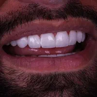 تخفیف های ویژه دندانپزشکی،کامپوزیت زیبایی،عصب کشی|خدمات آرایشگری و زیبایی|آبادان, |دیوار