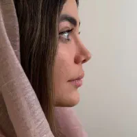 تغییر فرم بینی با روش رینوپلاستی نوین|خدمات آرایشگری و زیبایی|رشت, سعدی (تختی)|دیوار