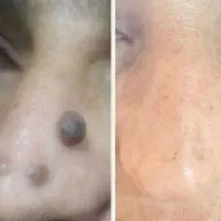 برداشتن انواع خال وزیگل با دستگاه لیزر پیشرفته|خدمات آرایشگری و زیبایی|ارومیه, |دیوار