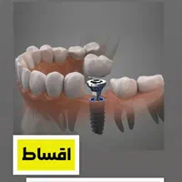 دندانپزشکی ((اقساط)) کامپوزیتـ ایمپلنت عصب کشی|خدمات آرایشگری و زیبایی|قدس, شهر‌قدس|دیوار
