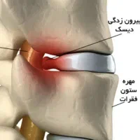درمان تضمینی دیسک کمر و گردن