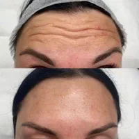 اموزش. بوتاکس فول فیس چشم گربه ای لیفت شقیقه|خدمات آرایشگری و زیبایی|خرم‌آباد, |دیوار