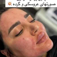 تزریق ژل و چربی و ساکشن وپرسینگ