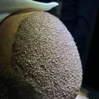 کاشت مو با تراکم بالا