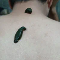 حجامت و زالو درمانی