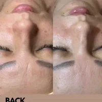 آفر پاکسازی صورت|خدمات آرایشگری و زیبایی|مشهد, ادیب نیشابوری (شهرک غرب)|دیوار