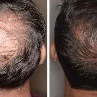 درمان صددرصدی مشکلات مو