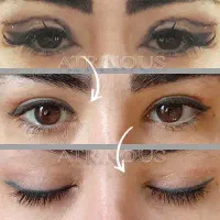 جراحی پلک / بلفاروپلاستی توسط پزشک مجرب