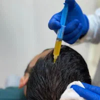 prp پی آر پی مو وصورت برای قطع ریزش و رویش مجدد مو|خدمات زیبایی و سلامت|اصفهان, خانه اصفهان|دیوار