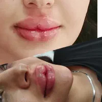 ژل وبوتاکس حمیدیه..|خدمات آرایشگری و زیبایی|حمیدیه, |دیوار