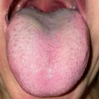 تشخیص بیماری از روی زبان