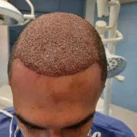 کاشت و تقویت مو به روش سلول های بنیادی