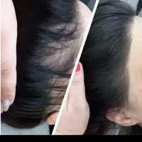 راه نجات کم‌پشتی مو با میکرواسکالپ|خدمات آرایشگری و زیبایی|دزفول, |دیوار