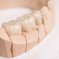 نیازمند یادگیریِ پرسلن گذاری(پروتز ثابت)