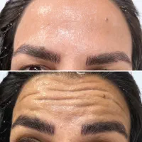 لیزر بوتاکس پی ارپی توسط دکتر|خدمات آرایشگری و زیبایی|مشهد, وکیلآباد|دیوار